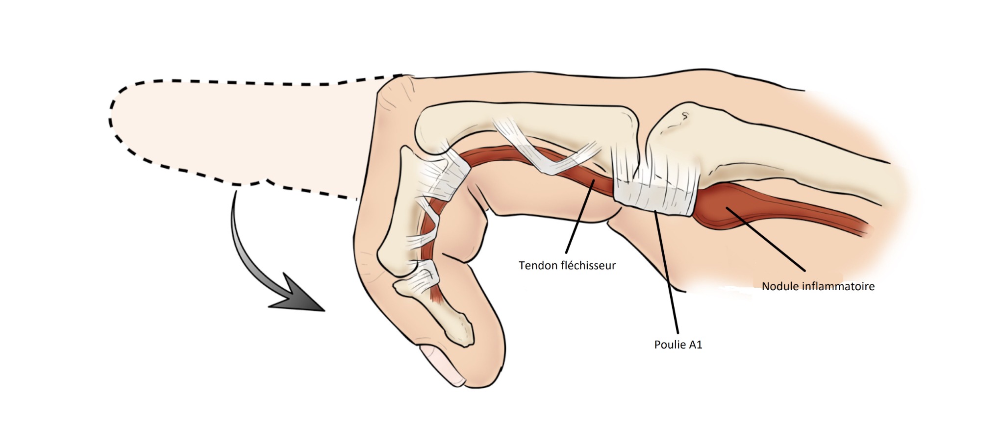 Anatomie du doigt à ressaut