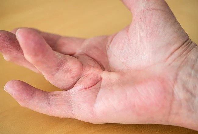 Anatomie du maladie de dupuytren