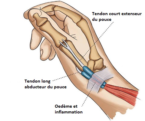 Anatomie du tendinite de de quervain